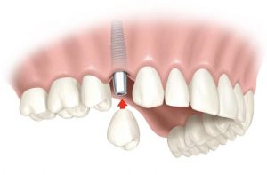 имплантация зубов кременчуг