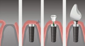 имплантация зубов кременчуг