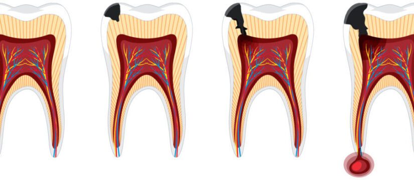Основні причини виникнення карієсу